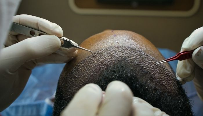 Sapphire FUE Hair Transplant